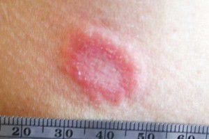 I Have A Rash In My Armpit - Doctor answers on HealthTap